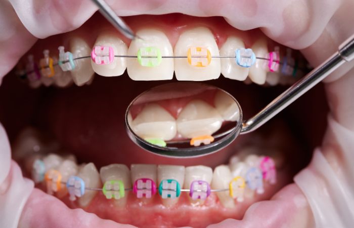  Dental Braces Treatment